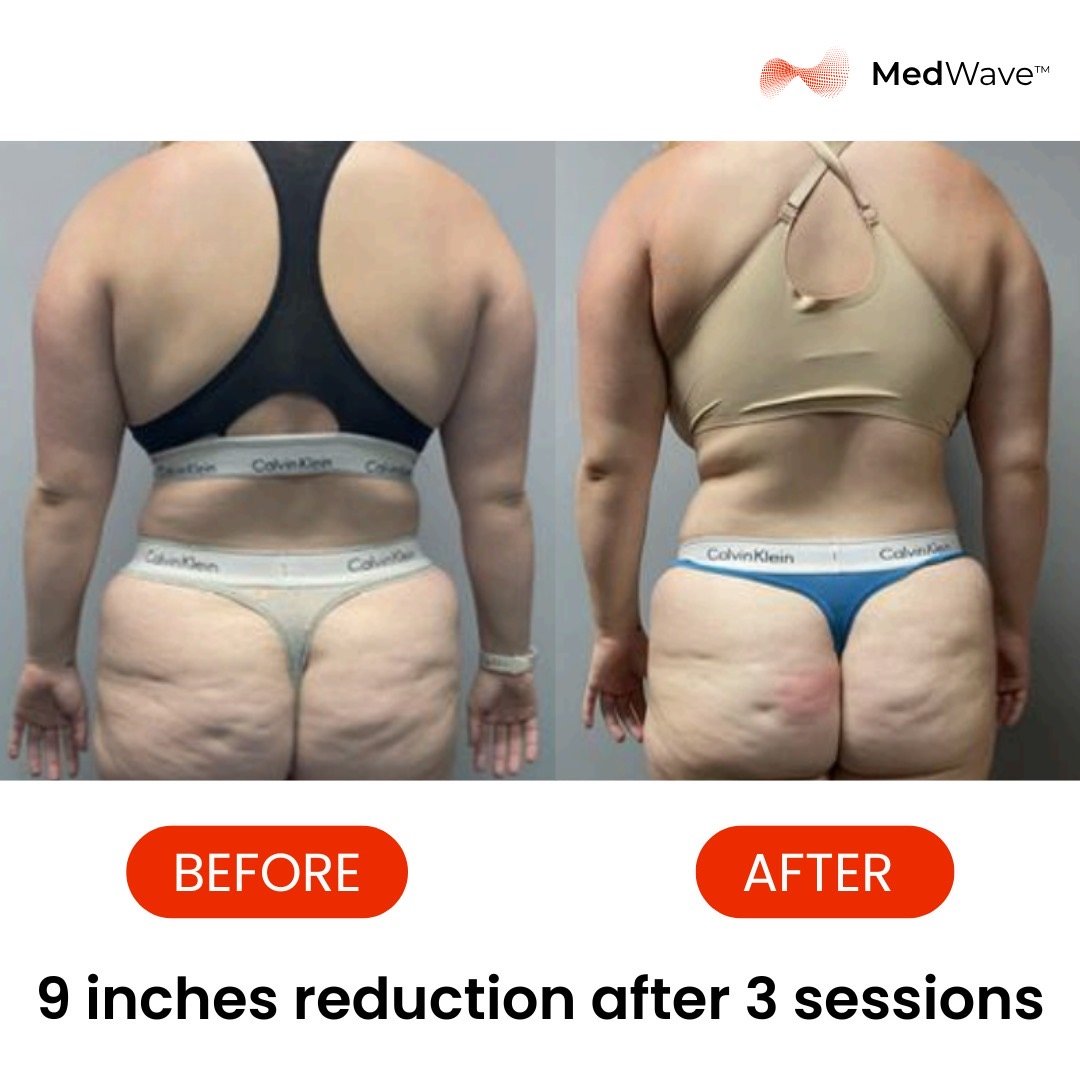 MedWave before and after results - back view